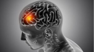 Waspada 5 Jenis Disabilitas yang tersebut yang dimaksud Sering Dialami Pasien Stroke